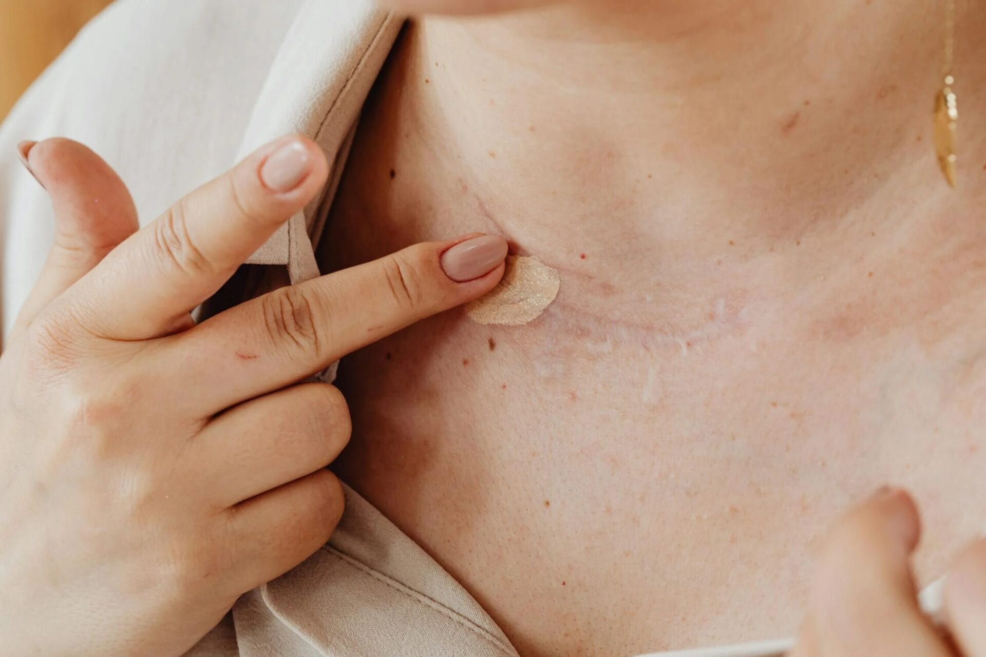 Scar therapy - The Scar Clinic Perth