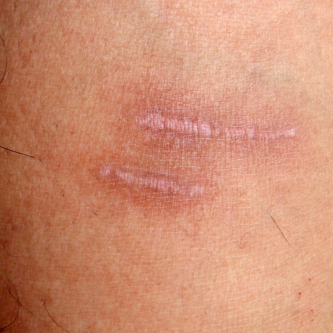 Cutaneous Conditions