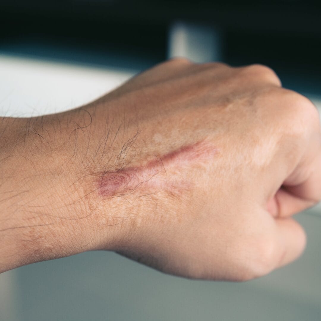 Hypertrophic Scar